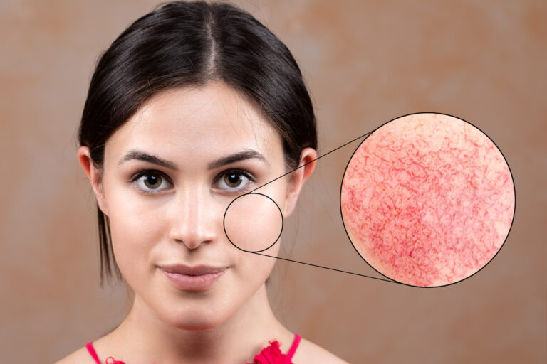 Couperose & Haarvaatjes Verwijderen picolaser