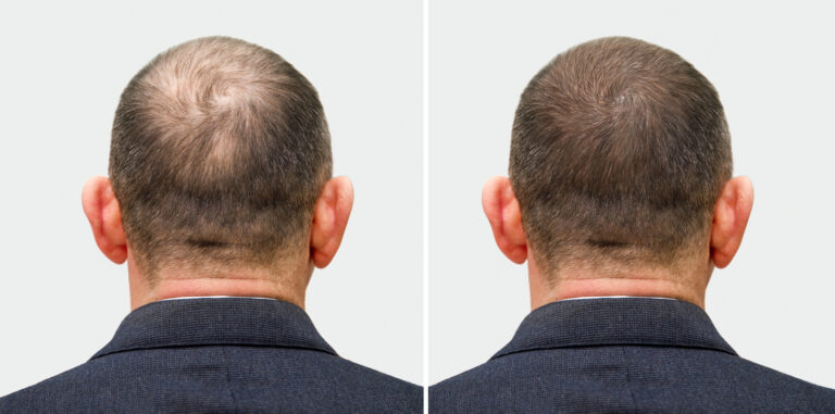Cursus Microhaar Shading (Scalp Shading)