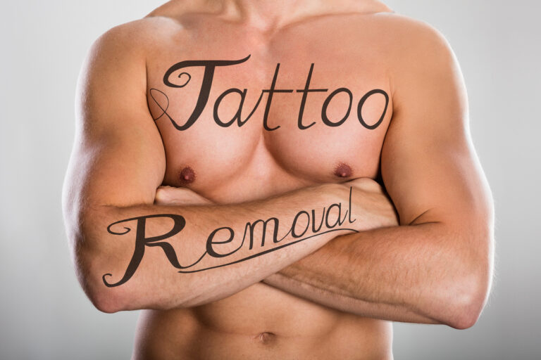 Online Cursus Tattoo Verwijderen met de Picolaser